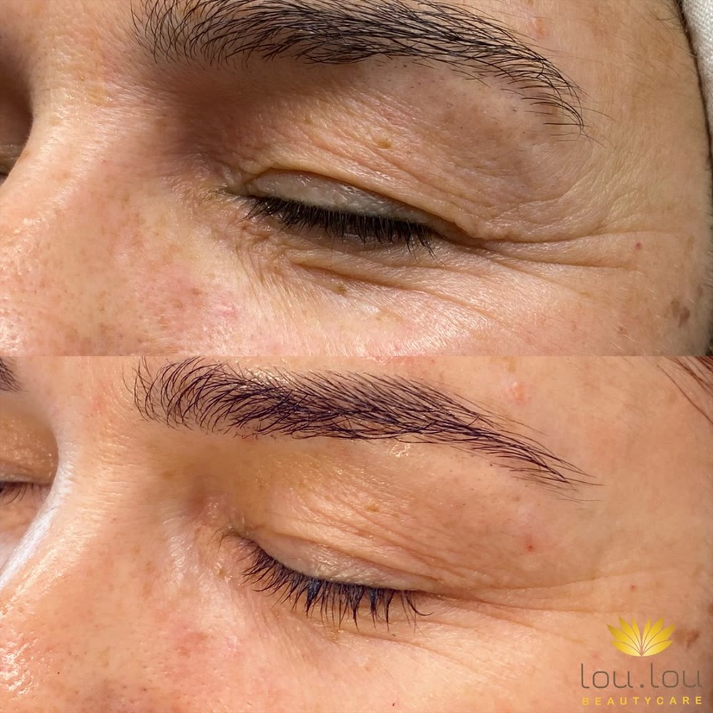 Vorher und nachher, echte Kundin von Lou.Lou Beautycare