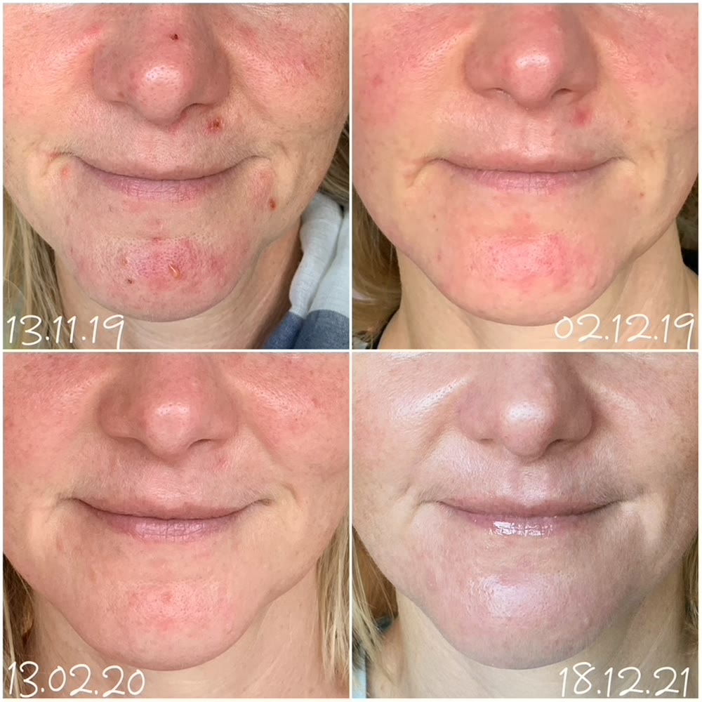 Vorher und nachher, echte Kundin von Lou.Lou Beautycare