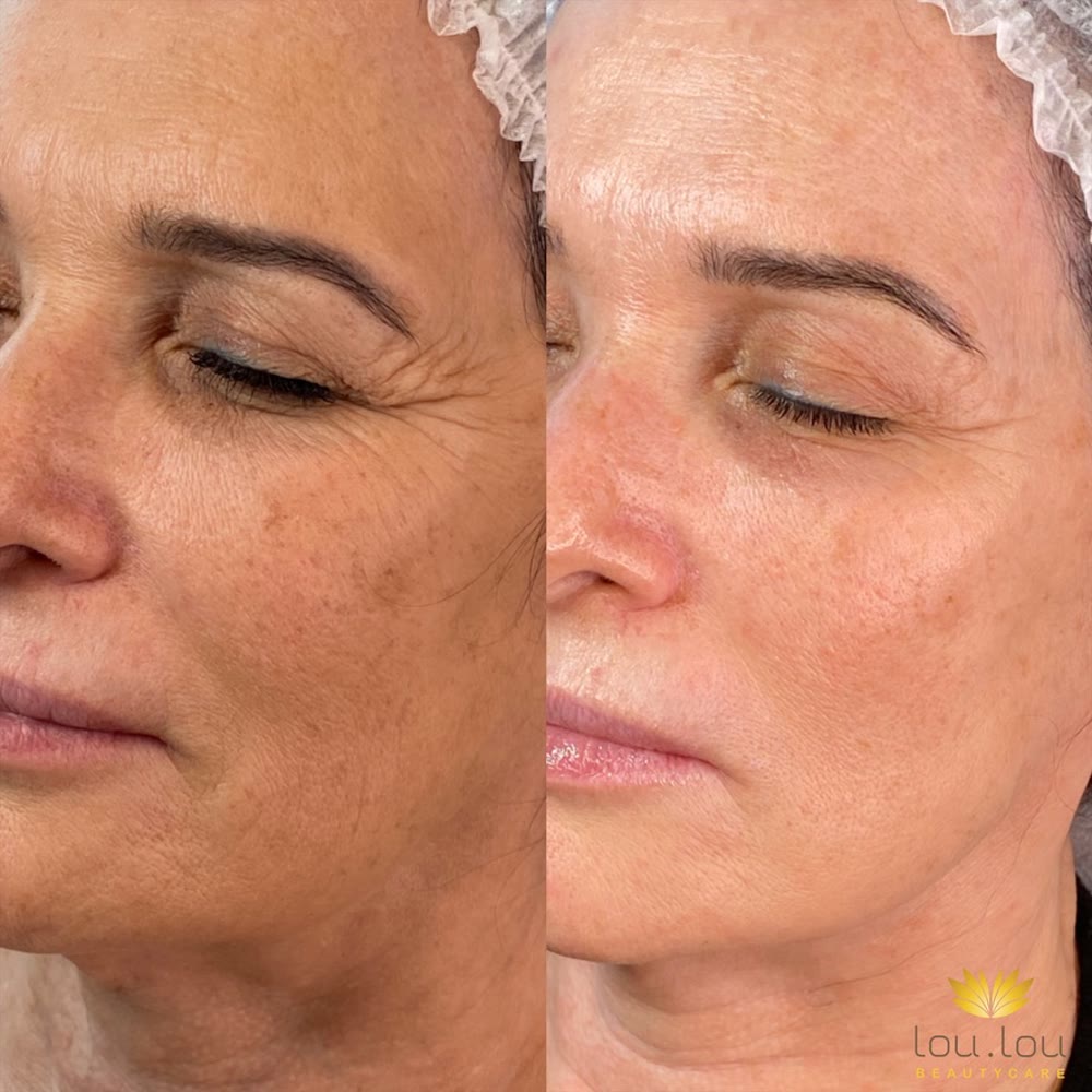 Vorher und nachher, echte Kundin von Lou.Lou Beautycare