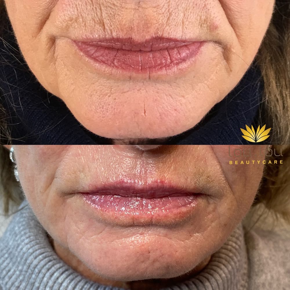 Vorher und nachher, echte Kundin von Lou.Lou Beautycare