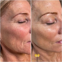 Vorher und nachher, echte Kundin von Lou.Lou Beautycare