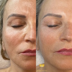 Vorher und nachher, echte Kundin von Lou.Lou Beautycare